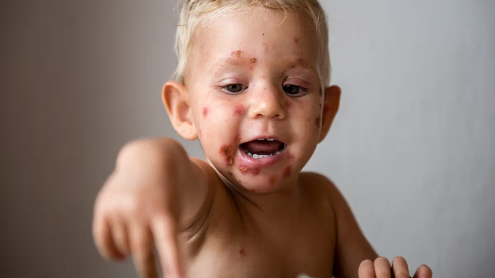 زرد زخم در کودکان چیست و چرا ایجاد می شود؟